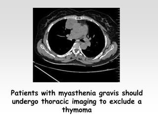 Patients with myasthenia gravis should
undergo thoracic imaging to exclude a
thymoma
 