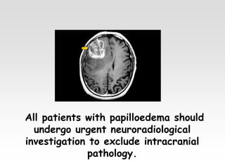 All patients with papilloedema should
undergo urgent neuroradiological
investigation to exclude intracranial
pathology.
 