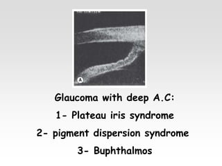 Glaucoma with deep A.C:
1- Plateau iris syndrome
2- pigment dispersion syndrome
3- Buphthalmos
 