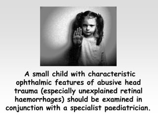 A small child with characteristic
ophthalmic features of abusive head
trauma (especially unexplained retinal
haemorrhages) should be examined in
conjunction with a specialist paediatrician.
 