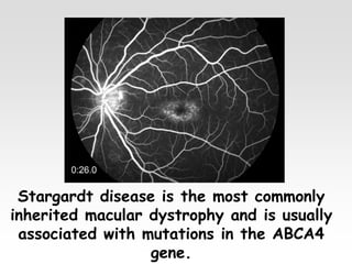 Stargardt disease is the most commonly
inherited macular dystrophy and is usually
associated with mutations in the ABCA4
gene.
 
