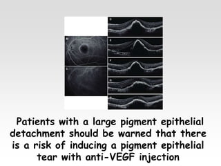 Patients with a large pigment epithelial
detachment should be warned that there
is a risk of inducing a pigment epithelial
tear with anti-VEGF injection
 