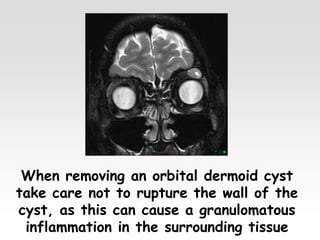 When removing an orbital dermoid cyst
take care not to rupture the wall of the
cyst, as this can cause a granulomatous
inflammation in the surrounding tissue
 