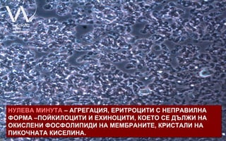 НУЛЕВА МИНУТА – АГРЕГАЦИЯ, ЕРИТРОЦИТИ С НЕПРАВИЛНА
ФОРМА –ПОЙКИЛОЦИТИ И ЕХИНОЦИТИ, КОЕТО СЕ ДЪЛЖИ НА
ОКИСЛЕНИ ФОСФОЛИПИДИ НА МЕМБРАНИТЕ, КРИСТАЛИ НА
ПИКОЧНАТА КИСЕЛИНА.
 