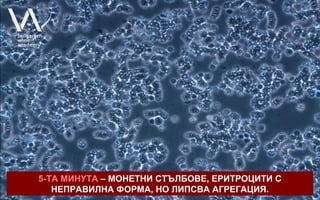 5-ТА МИНУТА – МОНЕТНИ СТЪЛБОВЕ, ЕРИТРОЦИТИ С
   НЕПРАВИЛНА ФОРМА, НО ЛИПСВА АГРЕГАЦИЯ.
 