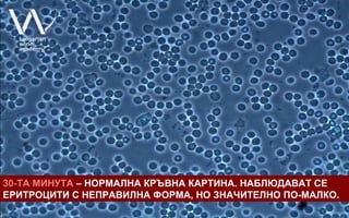 30-ТА МИНУТА – НОРМАЛНА КРЪВНА КАРТИНА. НАБЛЮДАВАТ СЕ
ЕРИТРОЦИТИ С НЕПРАВИЛНА ФОРМА, НО ЗНАЧИТЕЛНО ПО-МАЛКО.
 