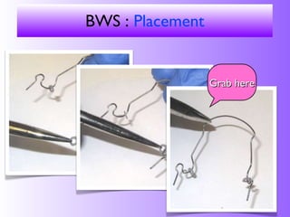 BWS placement and adjustment | PPT