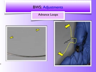 BWS placement and adjustment | PPT