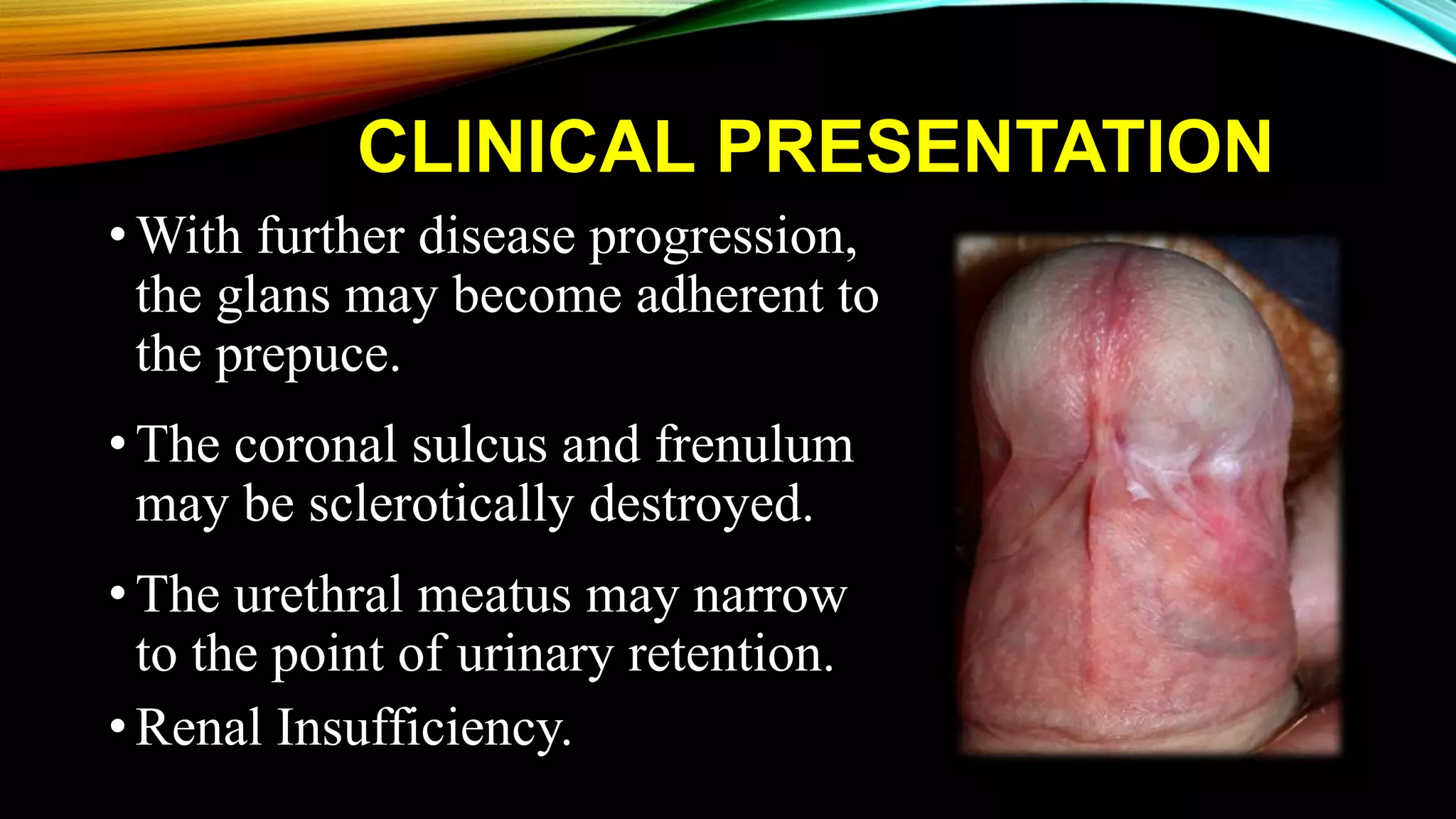 Balanitis Xerotica Obliterans / BXO / Penile Lichen Sclerosis | PPT