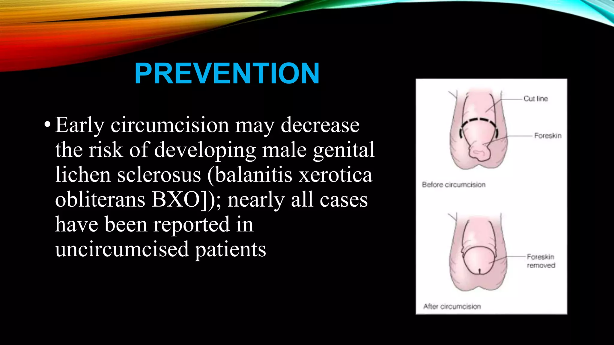 Balanitis Xerotica Obliterans BXO Penile Lichen Sclerosis PPTX
