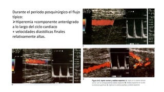 Durante el periodo posquirúrgico el flujo
típico:
Hiperemia +componente anterógrado
a lo largo del ciclo cardiaco
+ velocidades diastólicas finales
relativamente altas.
 