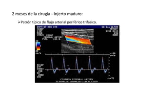 2 meses de la cirugía - Injerto maduro:
Patrón típico de flujo arterial periférico trifásico.
 