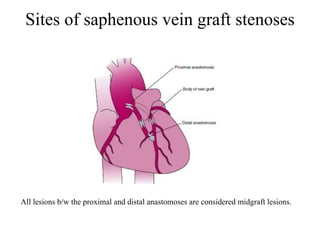 Sites of saphenous vein graft stenoses
All lesions b/w the proximal and distal anastomoses are considered midgraft lesions.
 