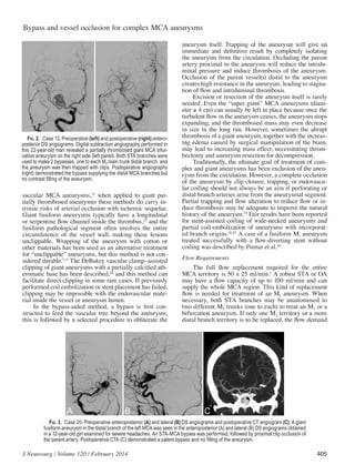 Bypass surgery for complex middle cerebral artery aneurysms | PDF
