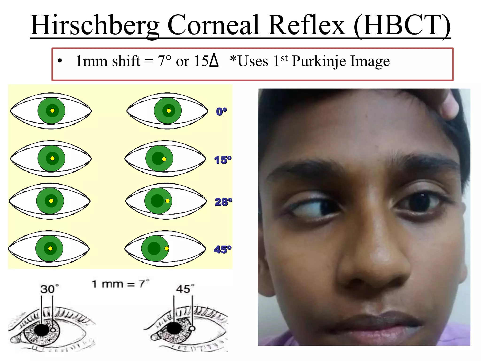 Hirschberg Examples By pd examination of a squint | PPTX