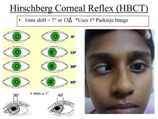 By pd examination of a squint | PPTX