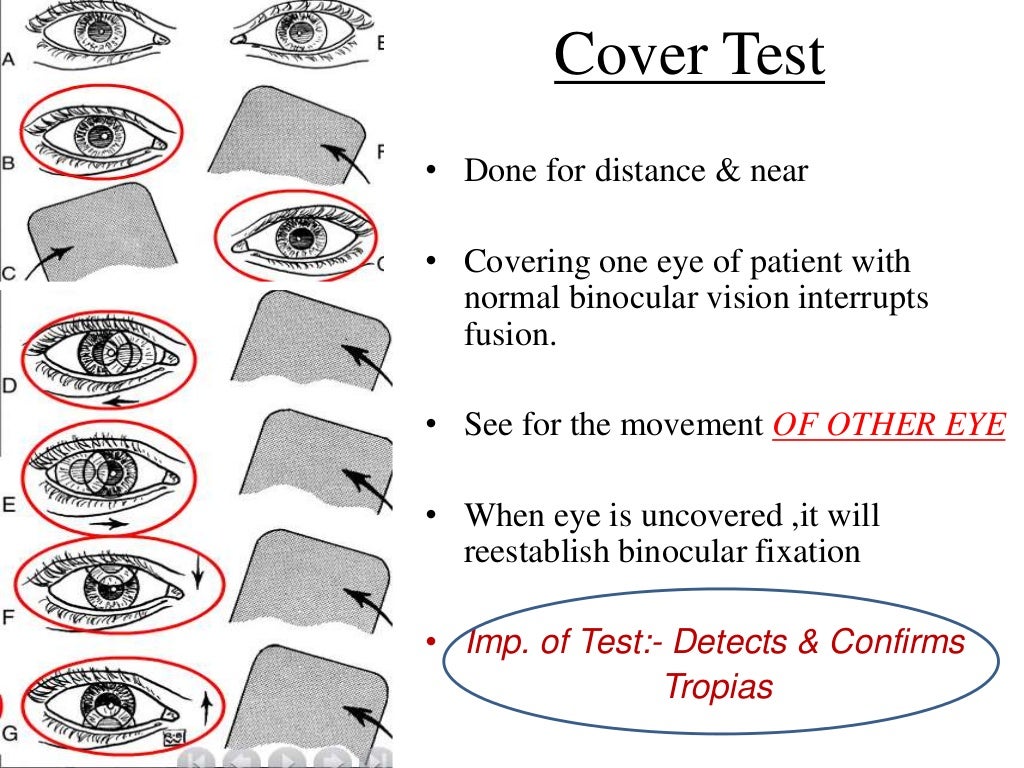 By pd examination of a squint