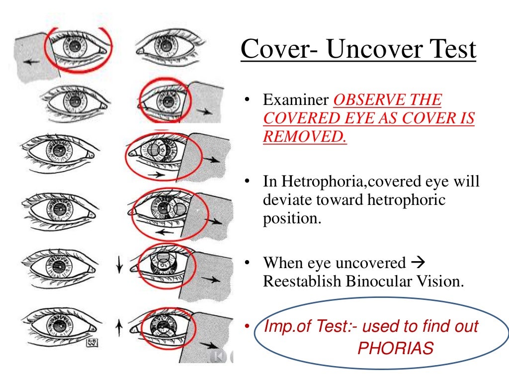 By pd examination of a squint