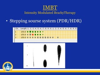 IMBT
Intensity Modulated BrachyTherapy
• Stepping sourse system (PDR/HDR)
 