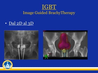 IGBT
Image Guided BrachyTherapy
• Dal 2D al 3D
 