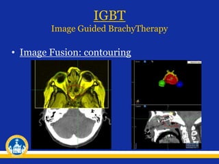 IGBT
Image Guided BrachyTherapy
• Image Fusion: contouring
 