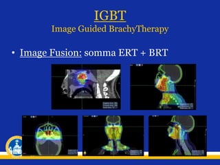 IGBT
Image Guided BrachyTherapy
• Image Fusion: somma ERT + BRT
 