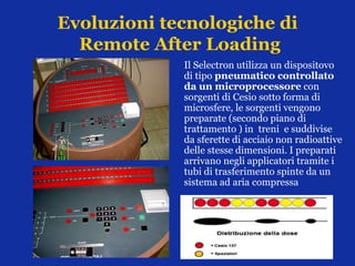 Evoluzioni tecnologiche di
Remote After Loading
Il Selectron utilizza un dispositovo
di tipo pneumatico controllato
da un microprocessore con
sorgenti di Cesio sotto forma di
microsfere, le sorgenti vengono
preparate (secondo piano di
trattamento ) in treni e suddivise
da sferette di acciaio non radioattive
delle stesse dimensioni. I preparati
arrivano negli applicatori tramite i
tubi di trasferimento spinte da un
sistema ad aria compressa
 