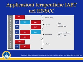 Applicazioni terapeutiche IABT
nel HNSCC
Meyer JE “Brachytherapy for the treatment of head and neck cancer “HNO. 2010 Sep;58(9):947-58.
 