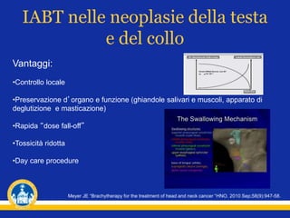 IABT nelle neoplasie della testa
e del collo
Vantaggi:
•Controllo locale
•Preservazione d’organo e funzione (ghiandole salivari e muscoli, apparato di
deglutizione e masticazione)
•Rapida “dose fall-off”
•Tossicità ridotta
•Day care procedure
Meyer JE “Brachytherapy for the treatment of head and neck cancer “HNO. 2010 Sep;58(9):947-58.
 