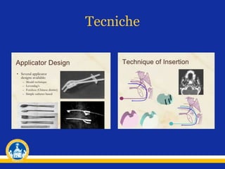 Tecniche
 