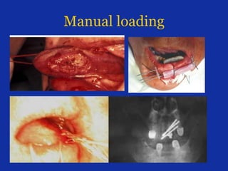 Manual loading
 