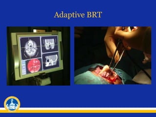Adaptive BRT
 