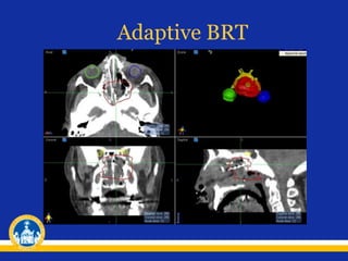 Adaptive BRT
 