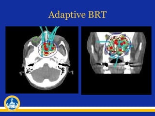 Adaptive BRT
 