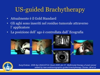 US-guided Brachytherapy
• Attualmente è il Gold Standard
• Gli aghi sono inseriti nel residuo tumorale attraverso
l’applicatore
• La posizione dell’ago è controllata dall’Ecografia
Surg Endosc. 2006 Apr;20(4):673-8. Epub 2006 Jan 21. Multimodal therapy of anal cancer
added by new endosonographic-guided brachytherapy. Doniec JM et al.
 