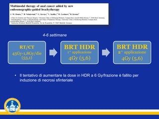 RT/CT
45Gy-1,8Gy/die
(53,1)
BRT HDR
1^ applicazione
4Gy (5,6)
BRT HDR
2^ applicazione
4Gy (5,6)
4-6 settimane
• Il tentativo di aumentare la dose in HDR a 6 Gy/frazione è fallito per
induzione di necrosi sfinteriale
 