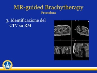 3. Identificazione del
CTV su RM
MR-guided Brachytherapy
Procedura
 