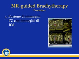 5. Fusione di immagini
TC con immagini di
RM
MR-guided Brachytherapy
Procedura
 