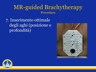 7. Inserimento ottimale
degli aghi (posizione e
profondità)
MR-guided Brachytherapy
Procedura
 