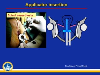 Spinal anaesthesia
Courtesy of Primož Petrič
Applicator insertion
 