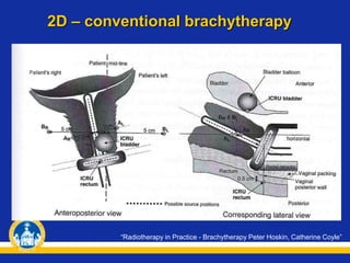 2D – conventional brachytherapy
“Radiotherapy in Practice - Brachytherapy Peter Hoskin, Catherine Coyle”
 