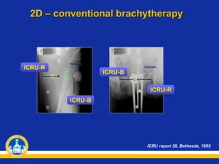 ICRU report 38, Bethesda, 1985.
ICRU-R
ICRU-B
ICRU-R
ICRU-B
2D – conventional brachytherapy
 