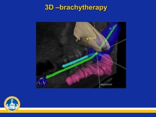 3D –brachytherapy
 