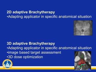 2D adaptive Brachytherapy
•Adapting applicator in specific anatomical situation
3D adaptive Brachytherapy
•Adapting applicator in specific anatomical situation
•image based target assessment
•3D dose optimization
 