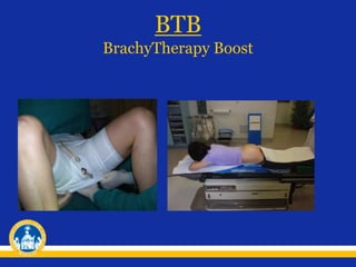 BTB
BrachyTherapy Boost
 