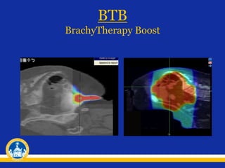 BTB
BrachyTherapy Boost
 