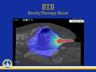 BTB
BrachyTherapy Boost
 