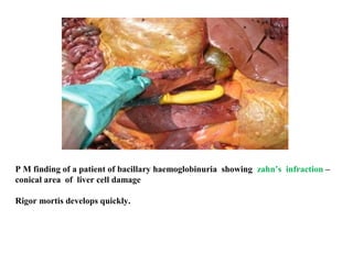 P M finding of a patient of bacillary haemoglobinuria showing zahn’s infraction –
conical area of liver cell damage
Rigor mortis develops quickly.
 