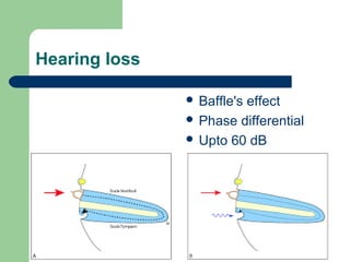 Hearing loss
 Baffle's effect
 Phase differential
 Upto 60 dB
 