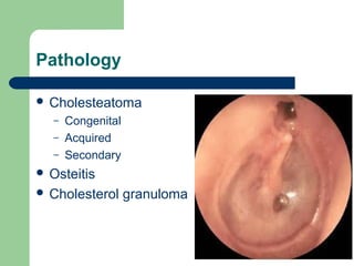 Pathology
 Cholesteatoma
– Congenital
– Acquired
– Secondary
 Osteitis
 Cholesterol granuloma
 